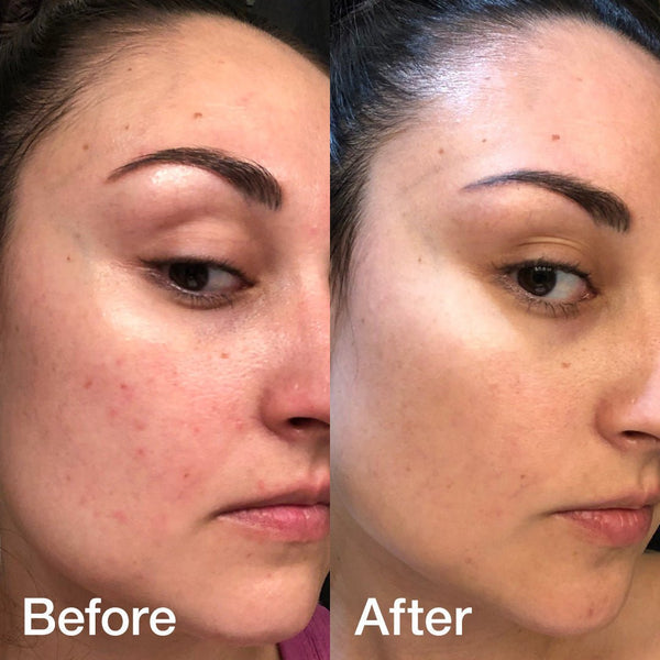 Atelo collagen